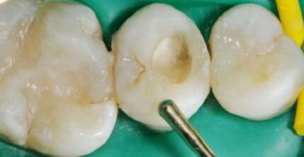 补牙后出现牙齿还疼怎么回事 该如何处理？