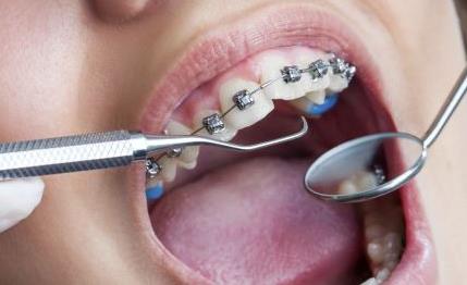 牙齿矫正是改善牙齿问题的一种方式 那牙齿矫正的危害有哪些呢