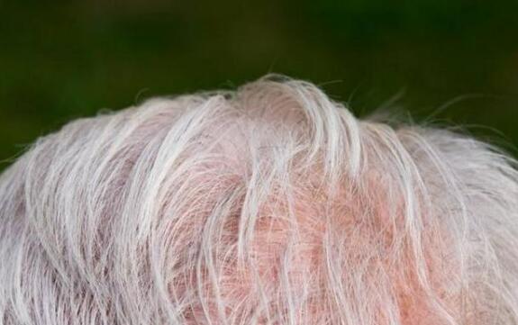 白头发越来越多怎么办 白头发的位置代表哪里有病