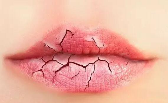 护唇保养有5个误区 应对嘴唇干裂的饮食方法