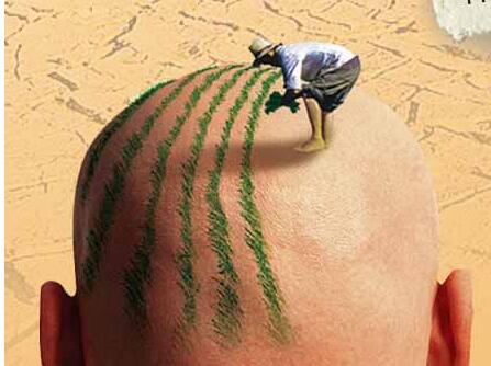 植发后多久可以洗头 植发前要注意什么问题?