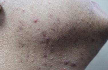 下巴上长痘怎么治 下巴祛痘排毒的食物