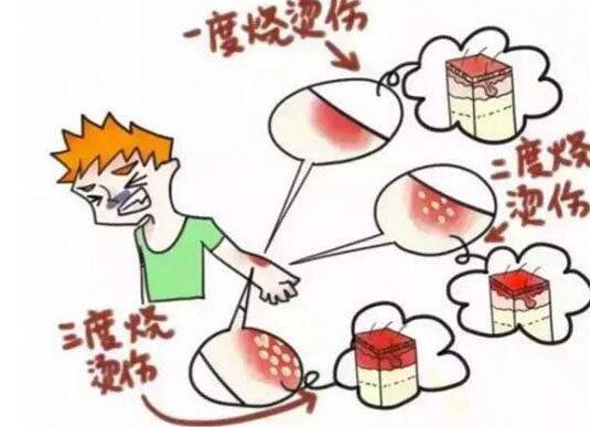 被油烫伤怎么处理 被热油烫伤的应急处理办法有哪些