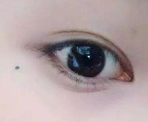 代表财富的痣相 痣长在这里就代表富贵的象征