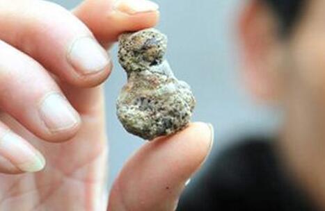 肾结石的危害有哪些 肾结石可导致身体疾病