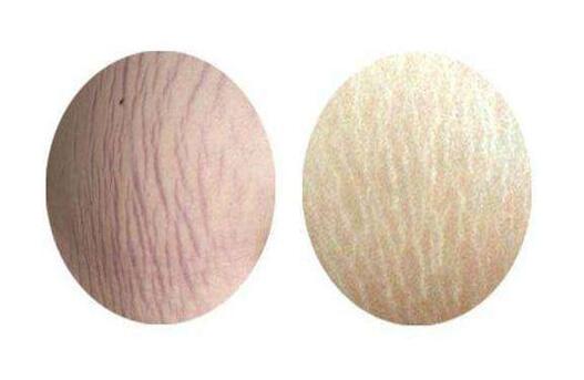 如何预防妊娠纹 妊娠纹生长了怎么消除？