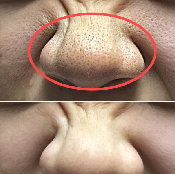 毛孔粗大严重影响颜值 4招小方法，再也不担心皮肤粗糙难看了！