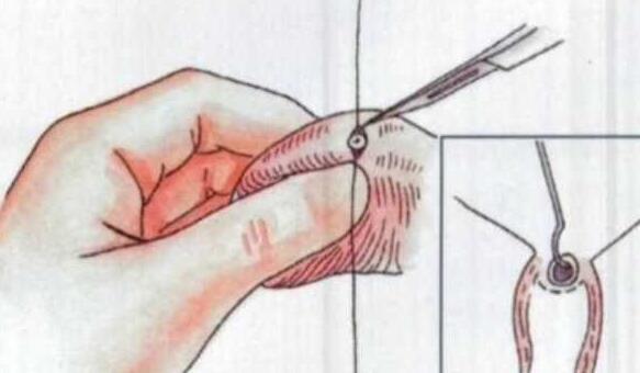 想要“长期避孕”女人上环和男人结扎哪个好？