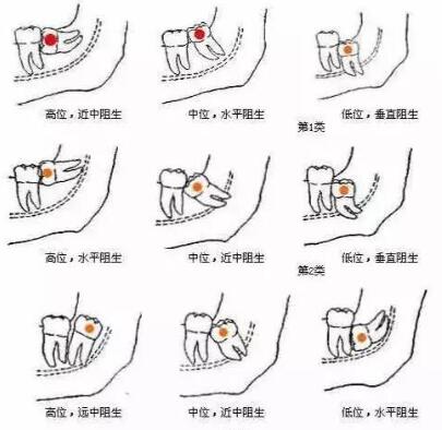 千万 不要 动不动 补牙，拔智齿后悔死了，不需要拔的智齿图片