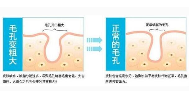 毛孔堵塞多数发生在什么人群呢?如何有效应对毛孔堵塞后的黑头