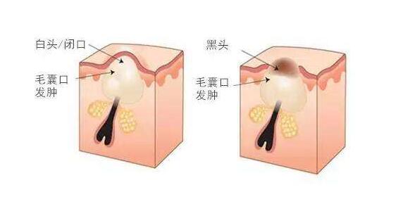 闭口黑头怎么来？ 这样做！和闭口黑头说拜拜