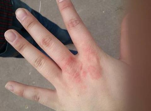 手上长小疙瘩原因别忽视 不明原因的乱用药耽误病情