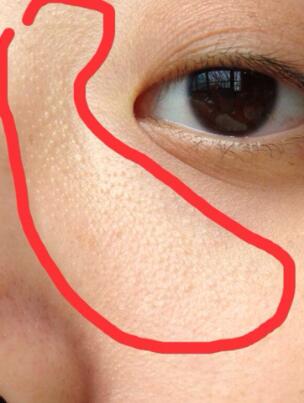 有脂肪粒的朋友  4个小窍门教你快速消除脂肪粒