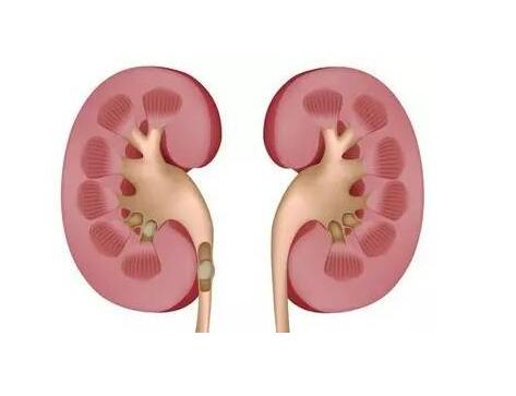 肾结石食疗防肾结石饮食4点建议 营养过剩是肾结石的“祸根