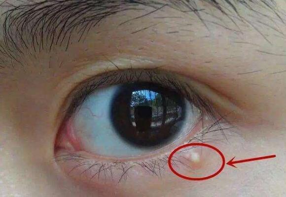 眼霜用了长脂肪粒？如何预防长脂肪粒