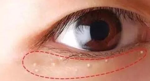 脂肪粒是怎么形成的？该如何应对？一定要保持健康的生活方式