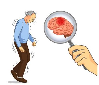 帕金森有年轻化趋势 要格外注意这四个帕金森前兆