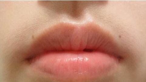 女孩子唇毛多是什么原因 怎么样去除唇毛