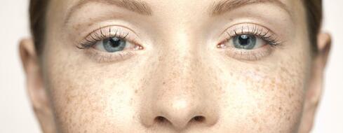 长雀斑应该注意什么 雀斑可用什么化妆品