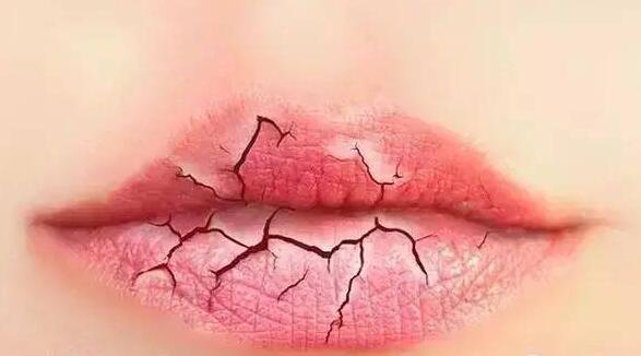 嘴唇干裂脱皮怎么办 嘴唇干裂脱皮抹蜂蜜有用吗