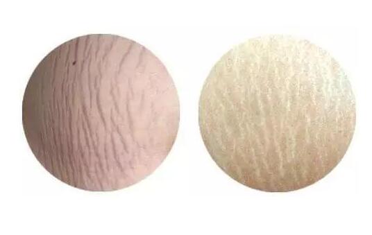 5种方法消除肥胖纹 教你怎样有效消除烦人纹路