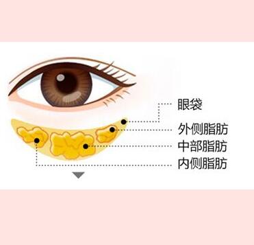 眼袋怎么快速消除 平时多按摩，多敷眼睛可以缓解