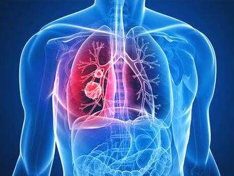 肺癌的早期症状到底有哪些?主要有这2点