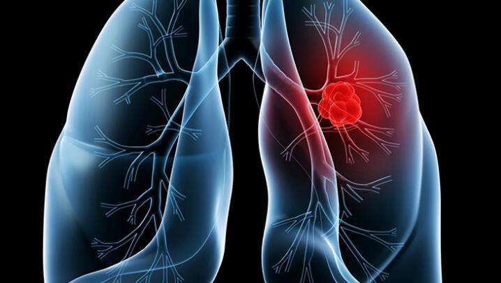 女性患肺癌，到底谁才是罪魁祸首？预防肺癌从三点做起