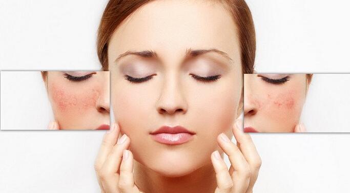 如何辨别脸上的斑是哪种？安全治疗雀斑方法！
