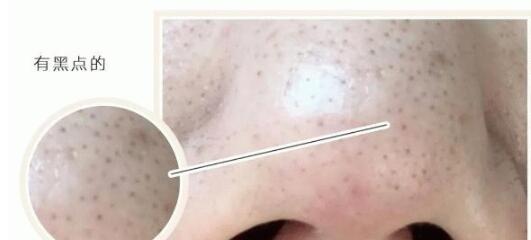 黑头是什么?什么才是正确的去黑头方法？