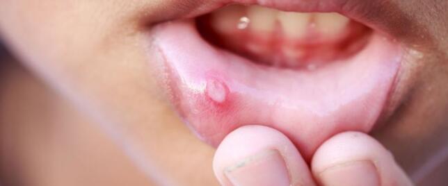 春季经常上火该怎么有效降火 出现上火的几种症状