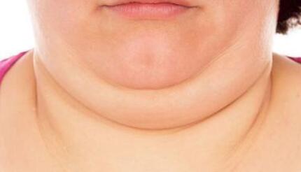 双下巴究竟是怎么产生的呢？如何瘦双下巴？