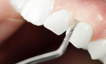 洗牙好不好 对牙齿有没有伤害？洗牙的好处与坏处介绍