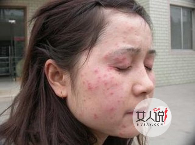 过敏性皮炎真的很让人苦恼,教你一招轻松应对它