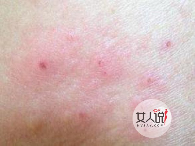 过敏性皮炎真的很让人苦恼,教你一招轻松应对它