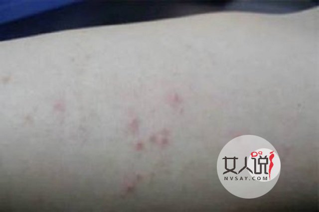 过敏性皮炎真的很让人苦恼,教你一招轻松应对它