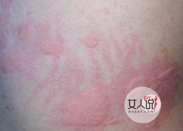 过敏性皮炎真的很让人苦恼,教你一招轻松应对它