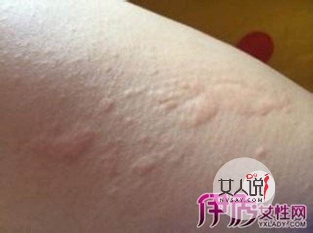 过敏性皮炎真的很让人苦恼,教你一招轻松应对它