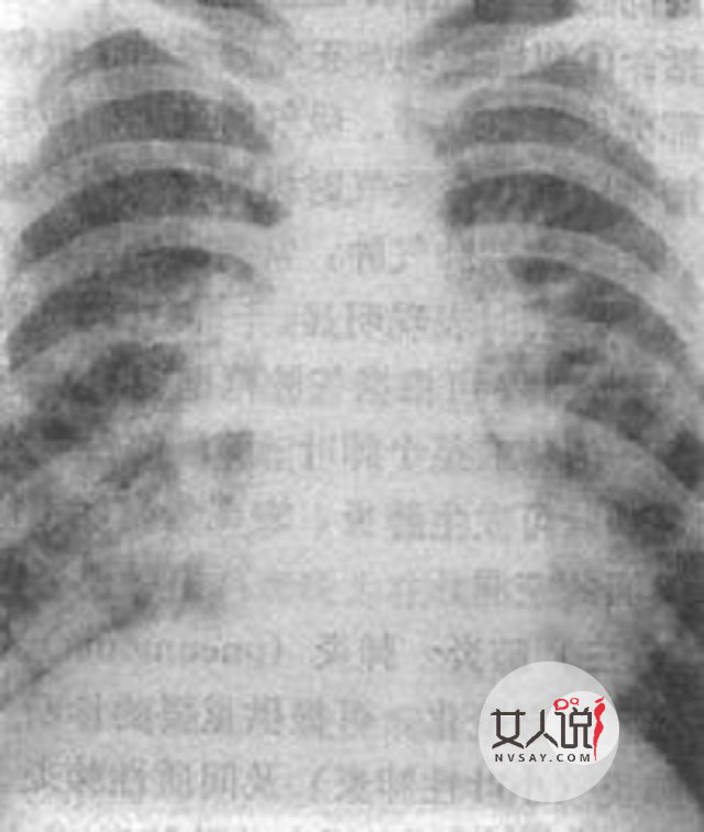 小孩支气管肺炎,你没办法?不能错过的小知识