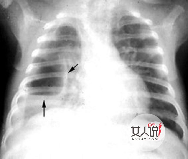 小孩支气管肺炎,你没办法?不能错过的小知识