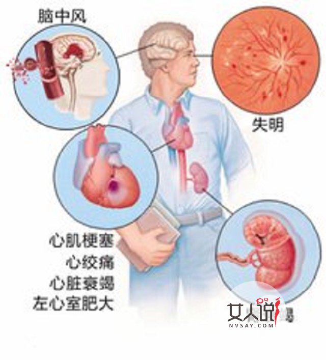 高血压的症状都有哪些?你中了吗?怎样预防高血压?