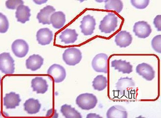 红细胞偏高?你还不知道是怎么了?快来看看有哪些原因吧