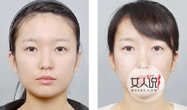瘦脸针多少钱一针?这些关于瘦脸针的注意事项你了解了吗