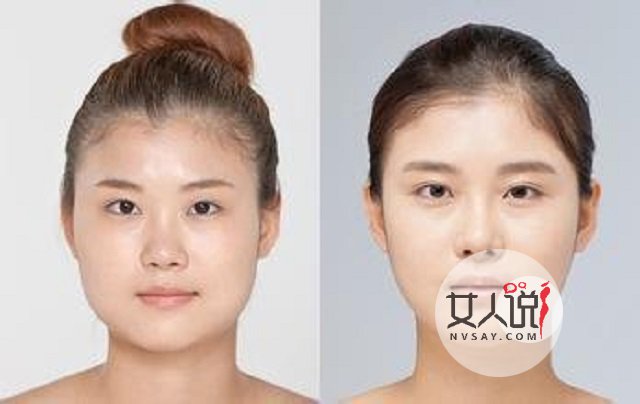 瘦脸针多少钱一针？这些关于瘦脸针的注意事项你了解了吗