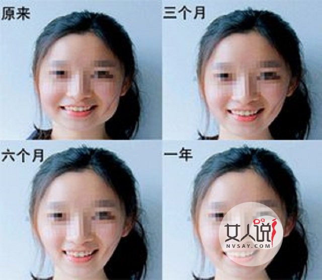 瘦脸针多少钱一针？这些关于瘦脸针的注意事项你了解了吗