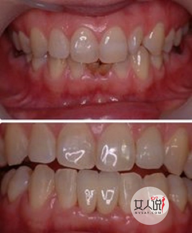 种植牙价格,种植牙有什么需要注意的事项,看这里就对了