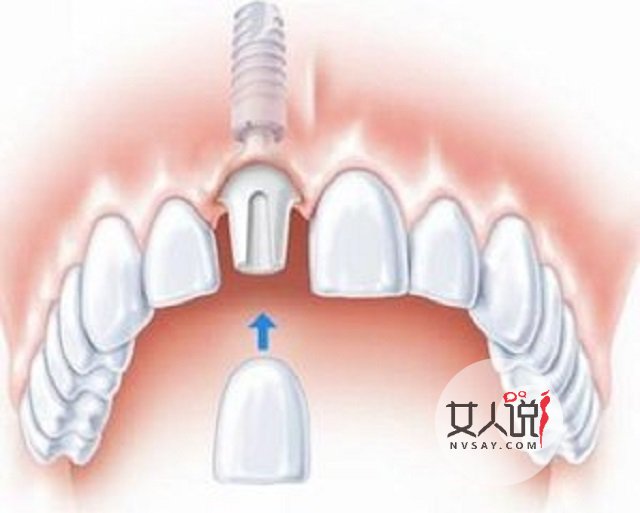 种植牙价格,种植牙有什么需要注意的事项,看这里就对了