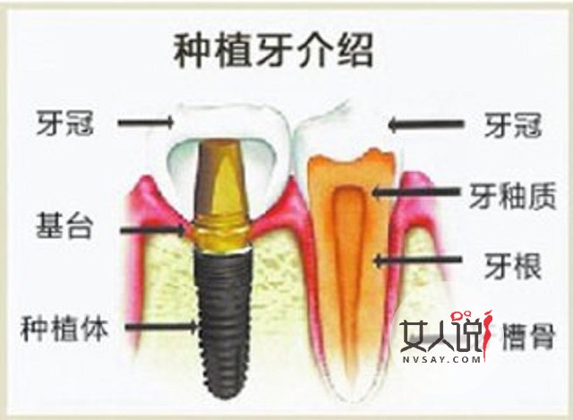 种植牙价格,种植牙有什么需要注意的事项,看这里就对了