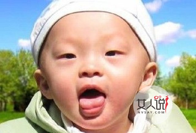 鹅口疮图片告诉你答案,千万别小看,有时甚至危及生命!!!