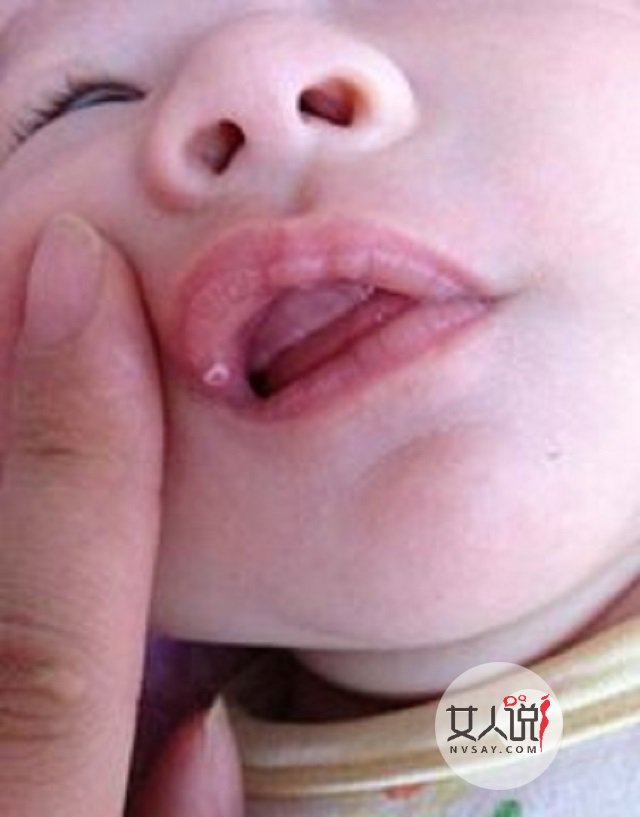 鹅口疮图片告诉你答案,千万别小看,有时甚至危及生命!!!